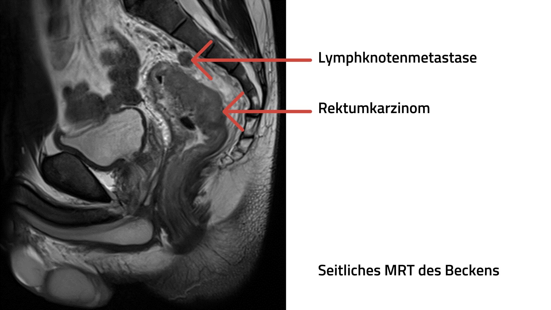 Seitliche Ansicht des Beckens von Christian S. Auf der MRT ist der bösartige Tumor im Dickdarm sowie eine Lymphknotenmetastase zu erkennen.