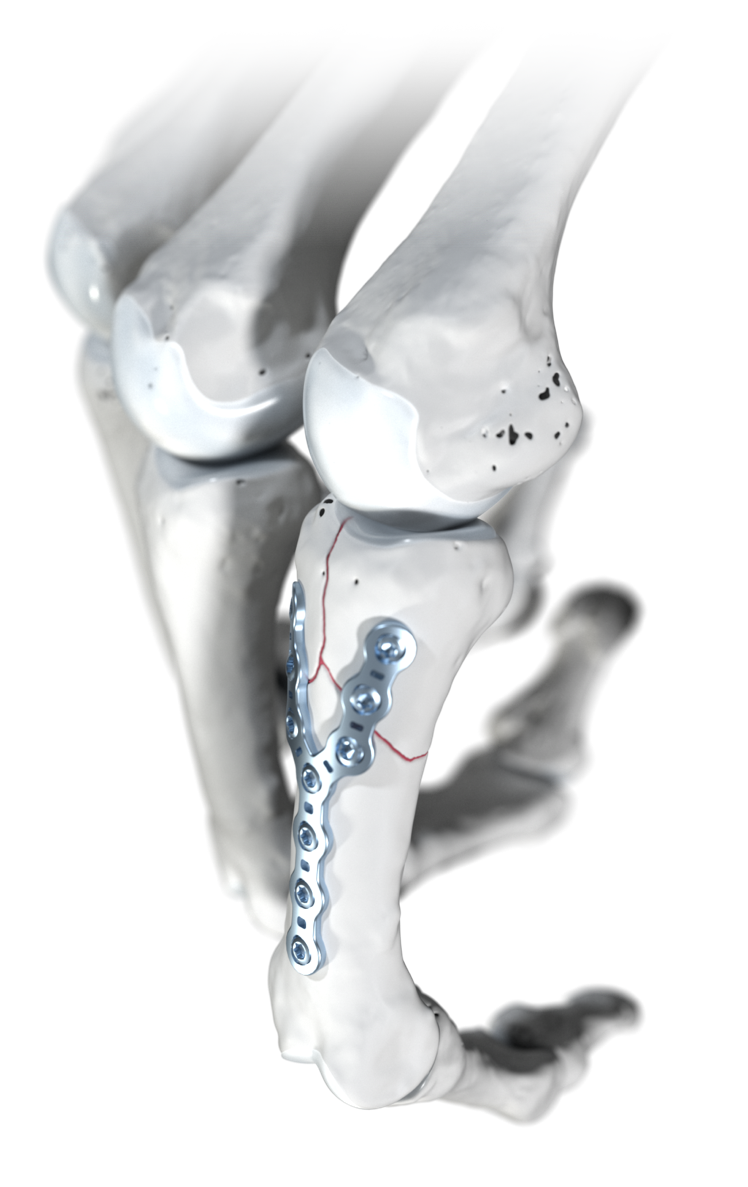 Die innovative Y-Platte ermöglicht eine präzise Versorgung komplexer Fingerfrakturen. Die innovative Y-Platte ermöglicht eine präzise Versorgung komplexer Fingerfrakturen.