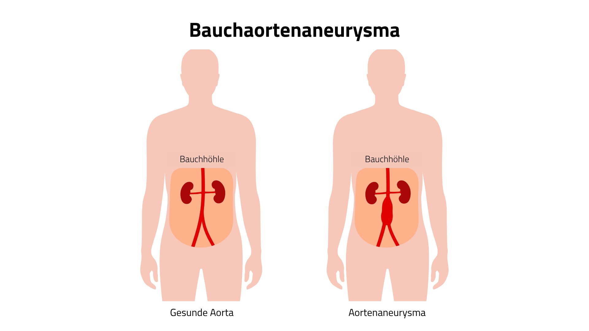 Schematische Darstellung eines Bauchaortenaneurysmas: Die Hauptschlagader ist im Bauchbereich krankhaft erweitert.