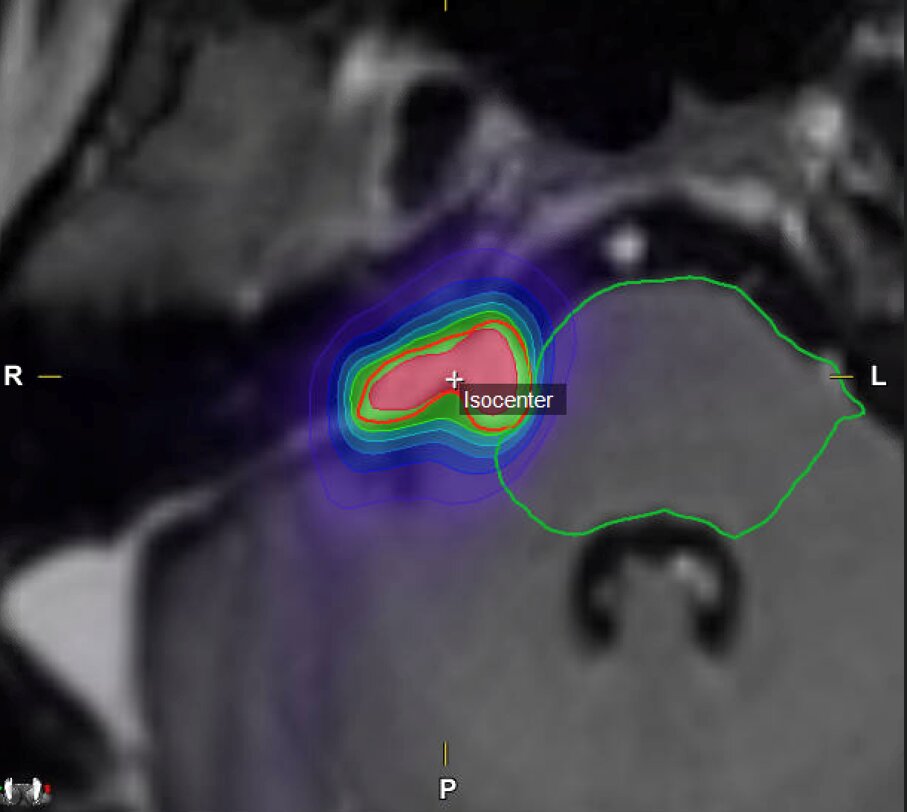 Die rote Linie zeigt die vom Team auf dem Planungs-MRT eingezeichnete Begrenzung des Tumors. Die grüne Linie zeigt die Begrenzung des Hirnstamms.      An diesem Bild sieht man gut, dass fast nur der Tumor und wenige Millimeter drum herum die Strahlung abbekommen. Wo keine Farbe zu sehen ist, kommt gar keine Strahlung hin, wo es leicht bläulich ist, nur minimal.