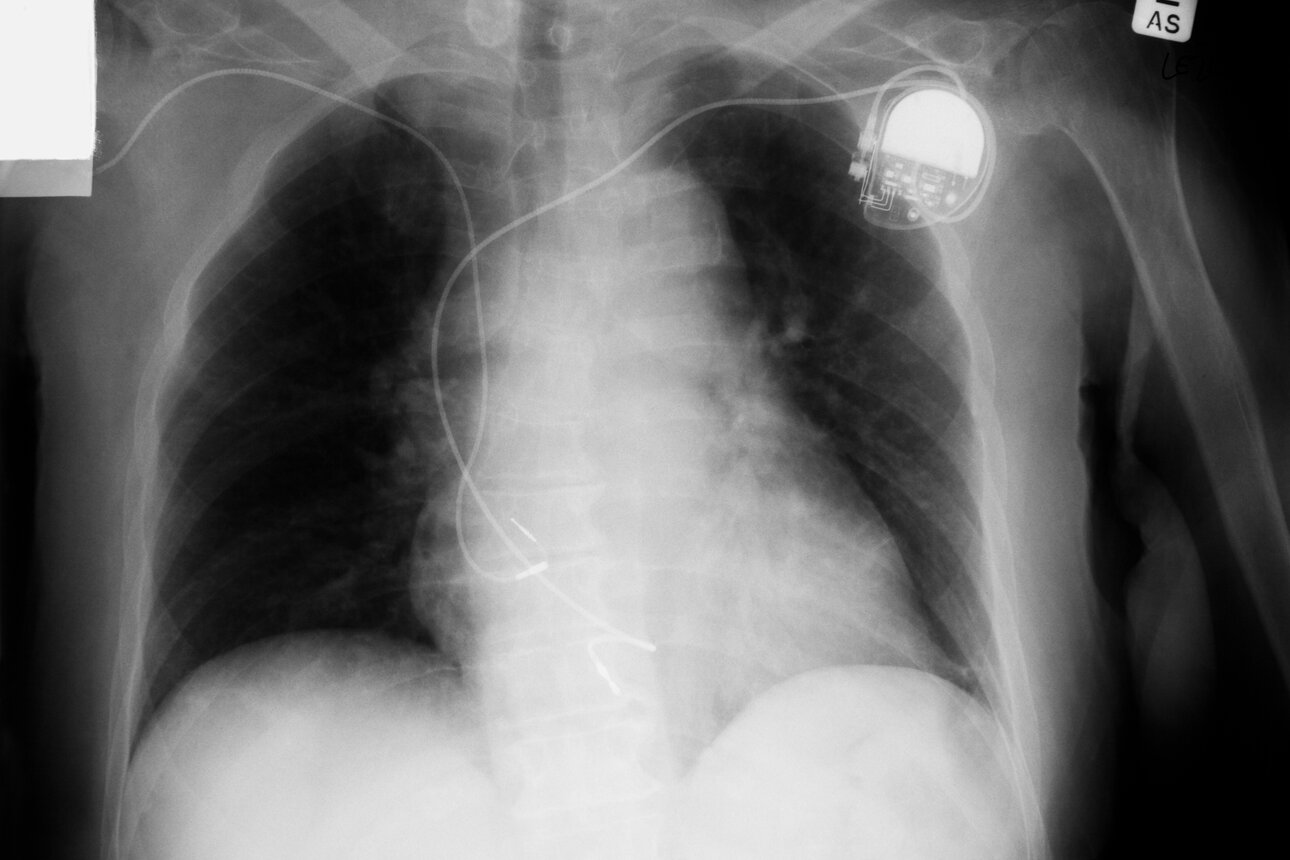 Implantierter Defibrillator (ICD).