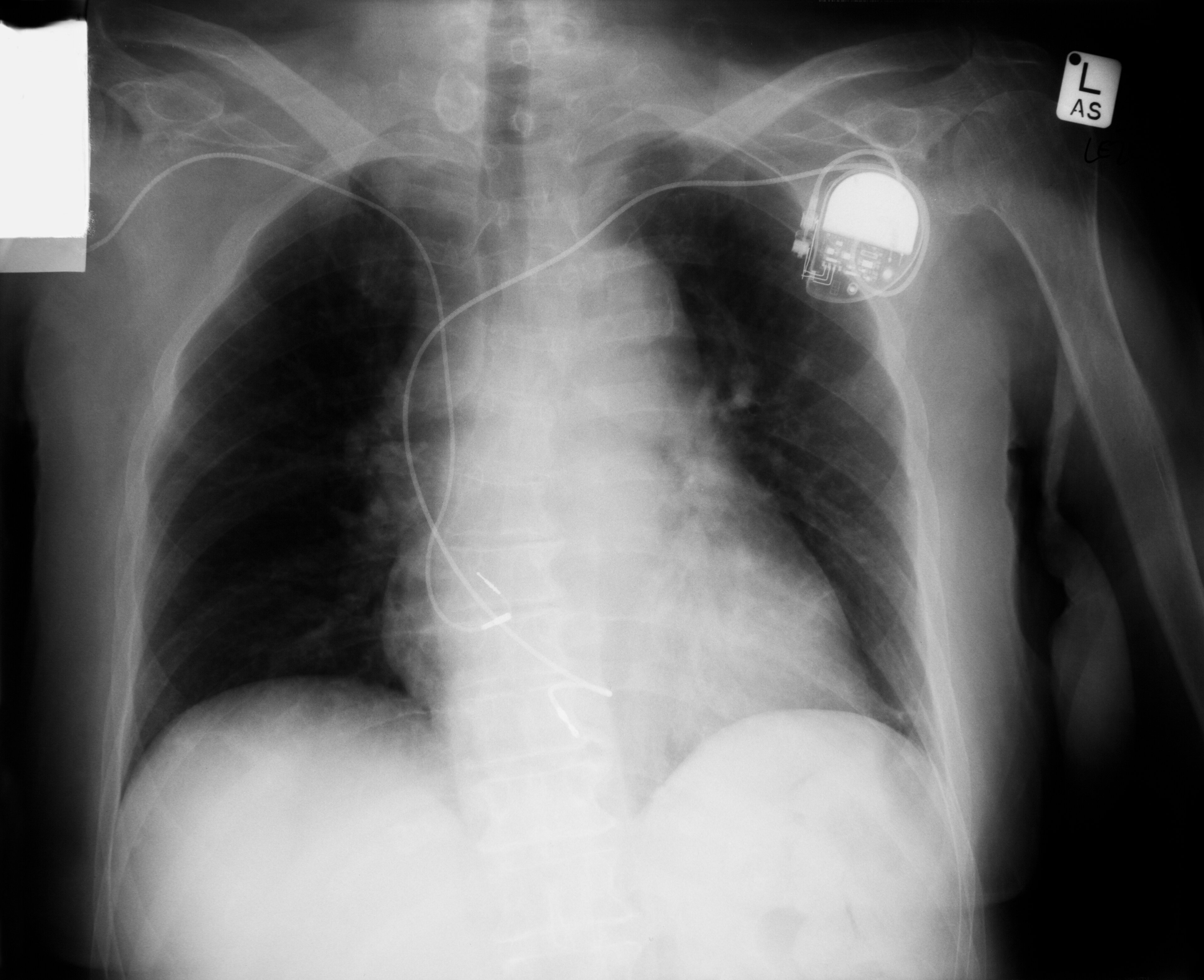 Implantierter Defibrillator (ICD).