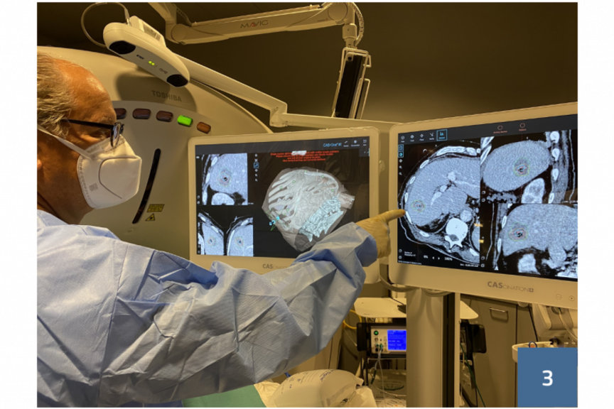 Thermoablation: Tumore mit feiner Nadel verbrennen